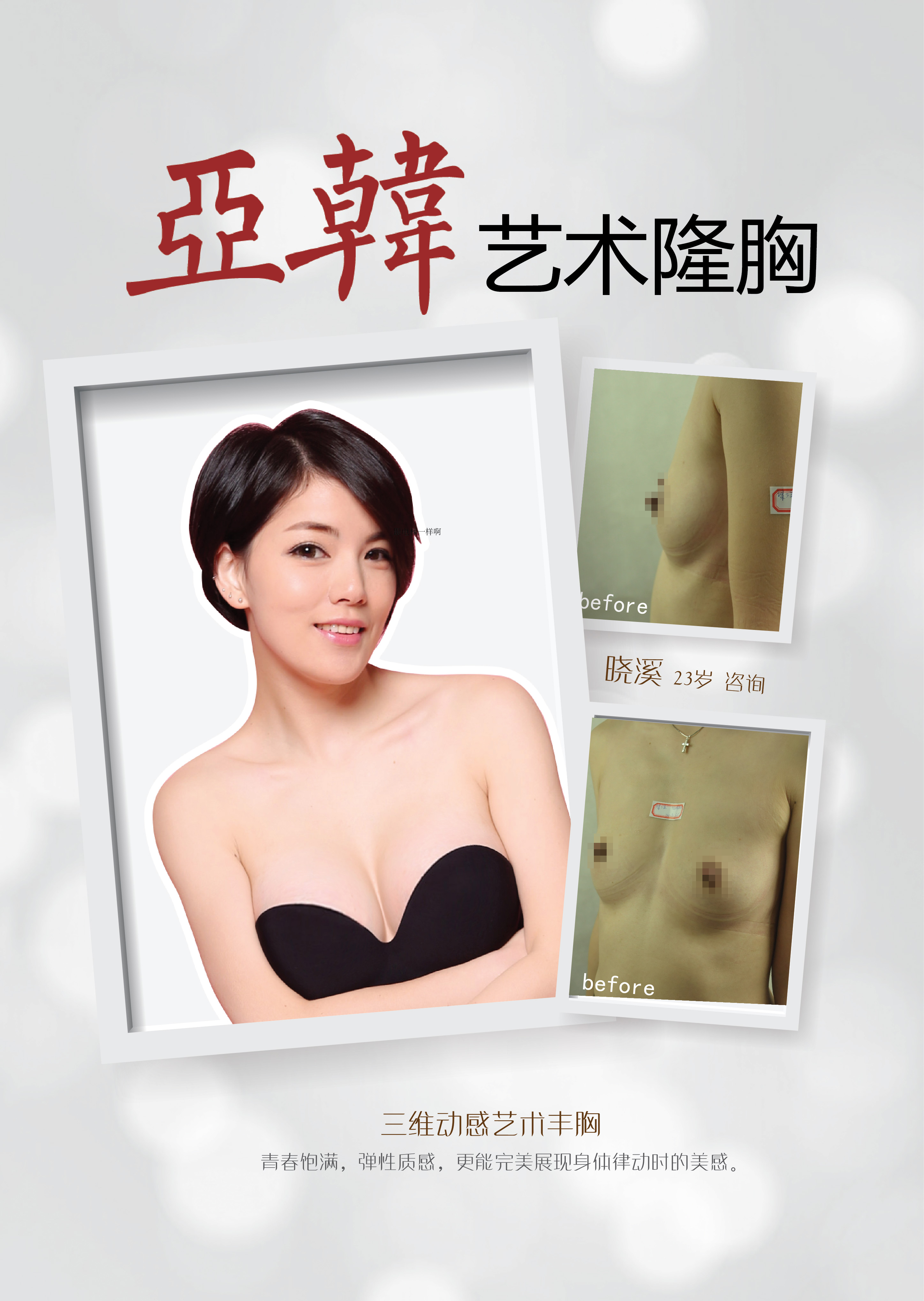 亚韩胸部整形案例